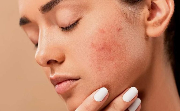 Mengenal Merkuri, Bahan Berbahaya pada Skincare