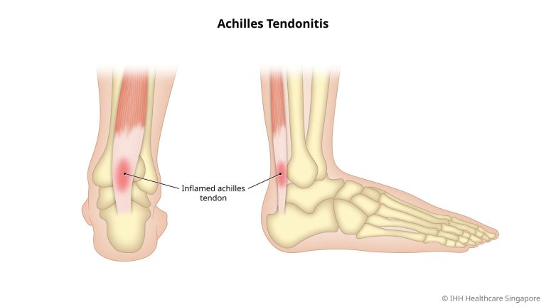 Tendon : Pengertian, Ciri-Ciri, Fungsi, Penyakit dan Cidera Tendon